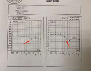 助听器选购避坑指南：验配 / 通道 / 降噪三大核心怎么看？这篇全讲透了